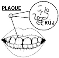 Drawing of a mouth with a diagram showing the plaque on the teeth.
